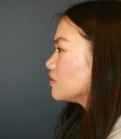 Feel Beautiful - Implant Top of Nose - Before Photo